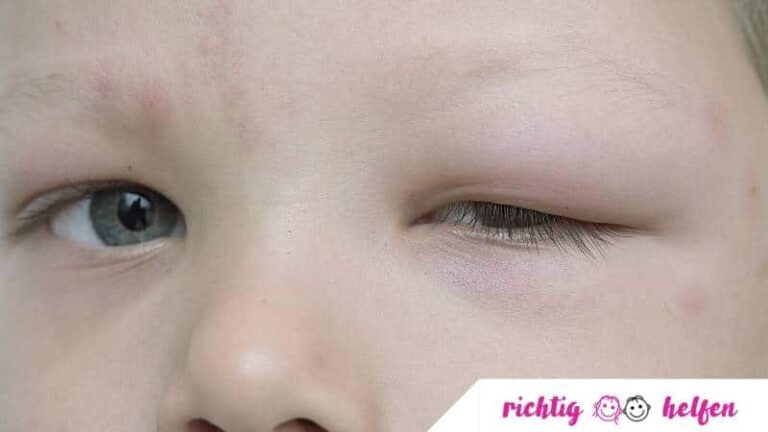 Mückenstich bei Baby